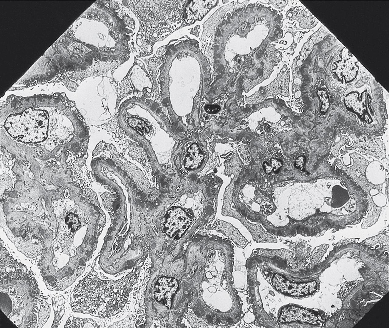 FIG. 3.85, Membranous nephropathy. In stage 2 membranous nephropathy, there are well-developed basement membrane reactions surrounding the evenly distributed subepithelial deposits (transmission electron microscopy, ×1200).