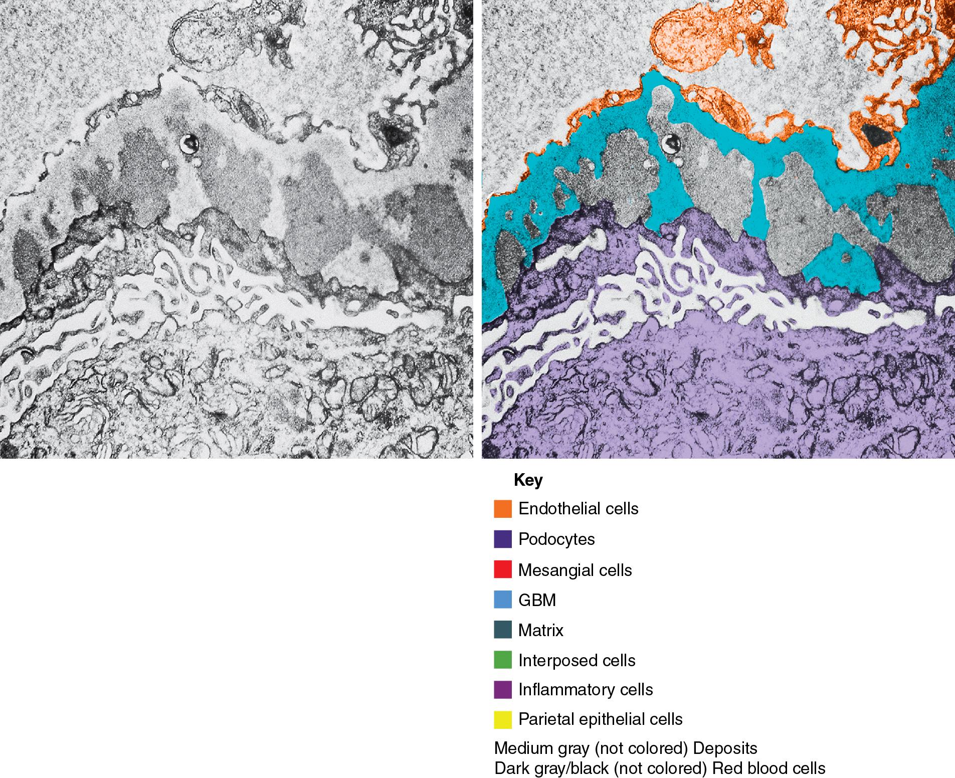 FIG. 3.86, Membranous nephropathy.