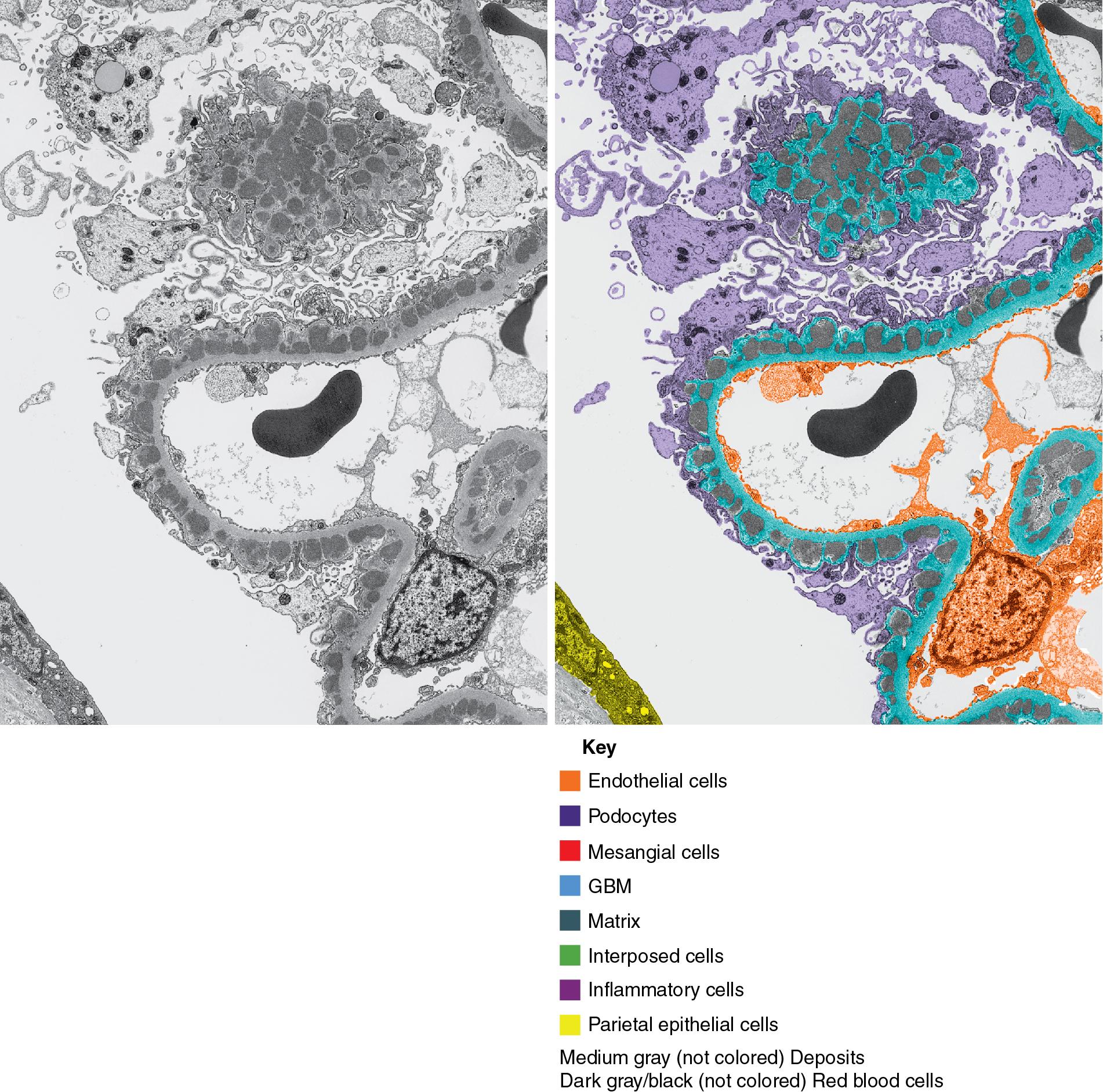 FIG. 3.88, Membranous nephropathy.