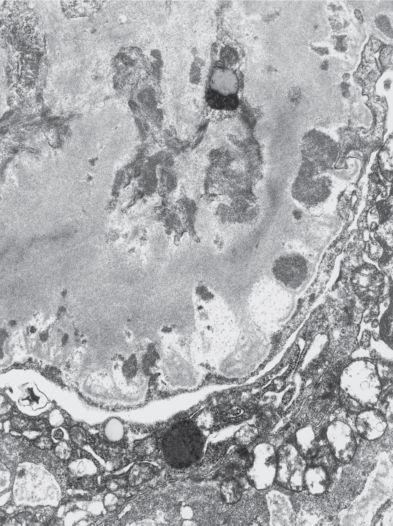 FIG. 3.89, Membranous nephropathy.