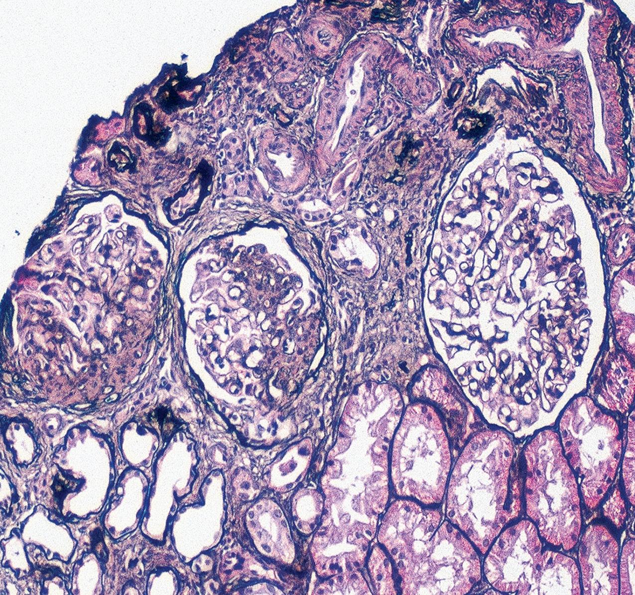 FIG. 3.9, Focal segmental glomerulosclerosis (FSGS).