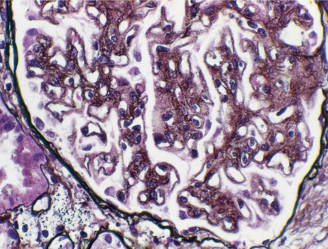 FIG. 3.91, Membranous nephropathy.