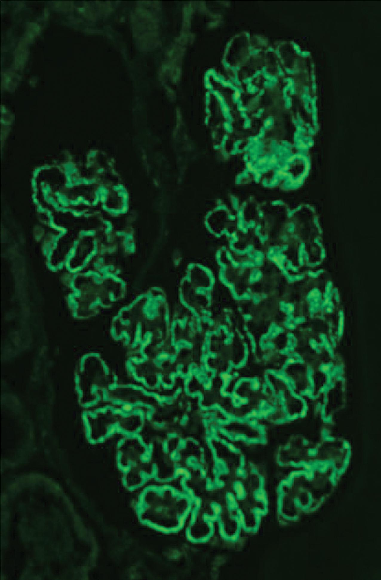 FIG. 3.92, Phospholipase A2 receptor (PLA2R)-positive membranous nephropathy. There is an evenly distributed granular capillary loop pattern of positivity for PLA2R in this case of membranous nephropathy, corresponding to the evenly distributed subepithelial deposits seen by electron microscopy, and by standard immunofluorescence. About 70% of apparent primary membranous nephropathies have capillary wall deposits that stain for PLA2R (anti-PLA2R immunofluorescence, ×400).