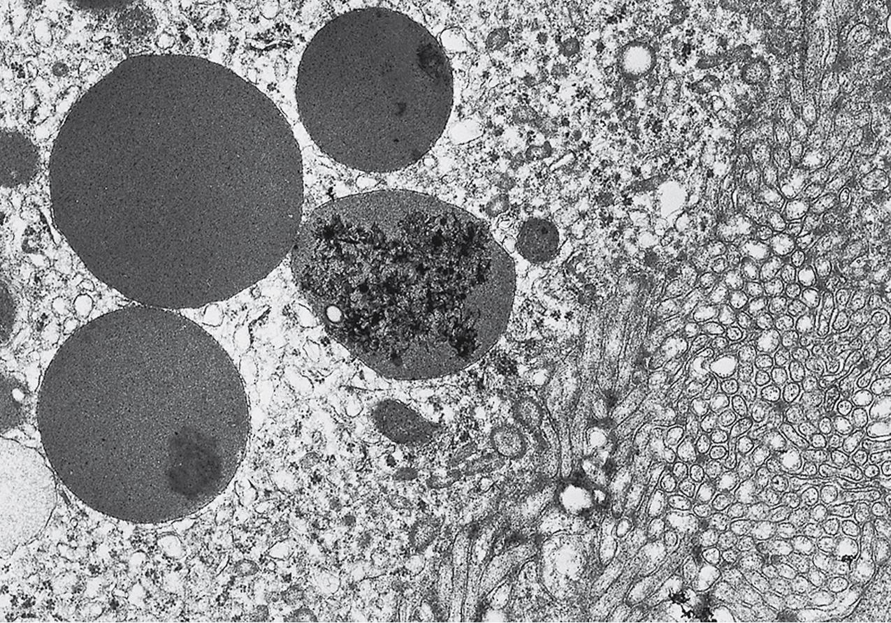 FIG. 3.93, Membranous nephropathy.