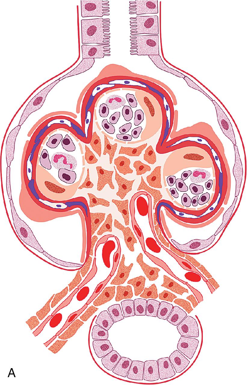 FIG. 3.94, Membranoproliferative glomerulonephritis (MPGN).