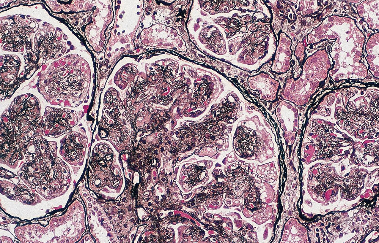 FIG. 3.96, Membranoproliferative glomerulonephritis (MPGN).