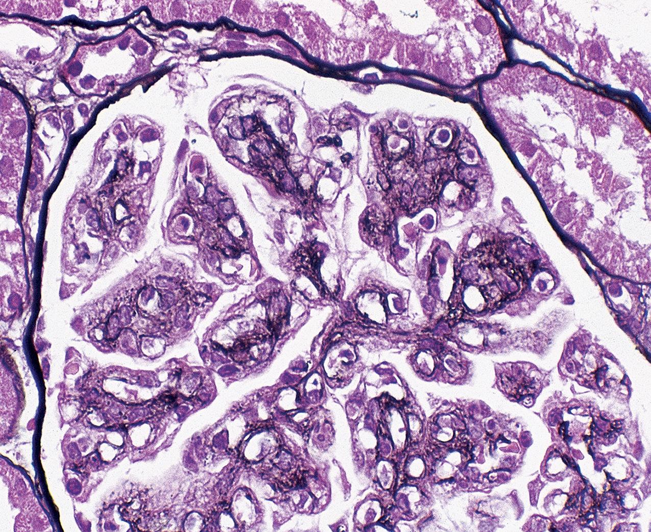 FIG. 3.97, Membranoproliferative glomerulonephritis (MPGN).