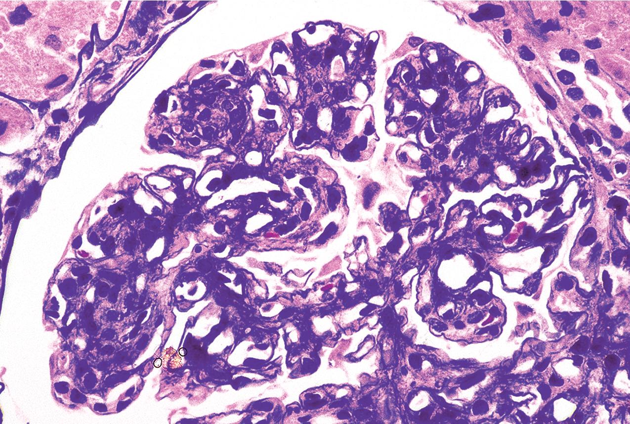 FIG. 3.98, Membranoproliferative glomerulonephritis (MPGN).