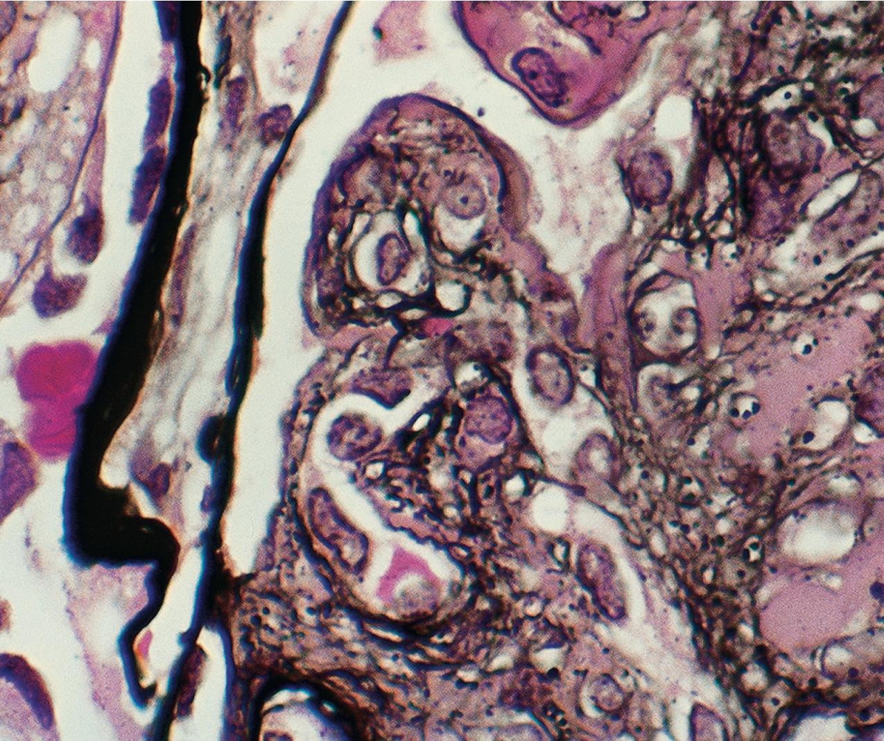 FIG. 3.99, Membranoproliferative glomerulonephritis (MPGN).