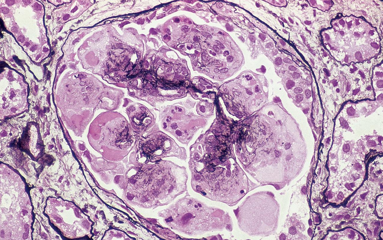 FIG. 3.100, Membranoproliferative glomerulonephritis (MPGN).