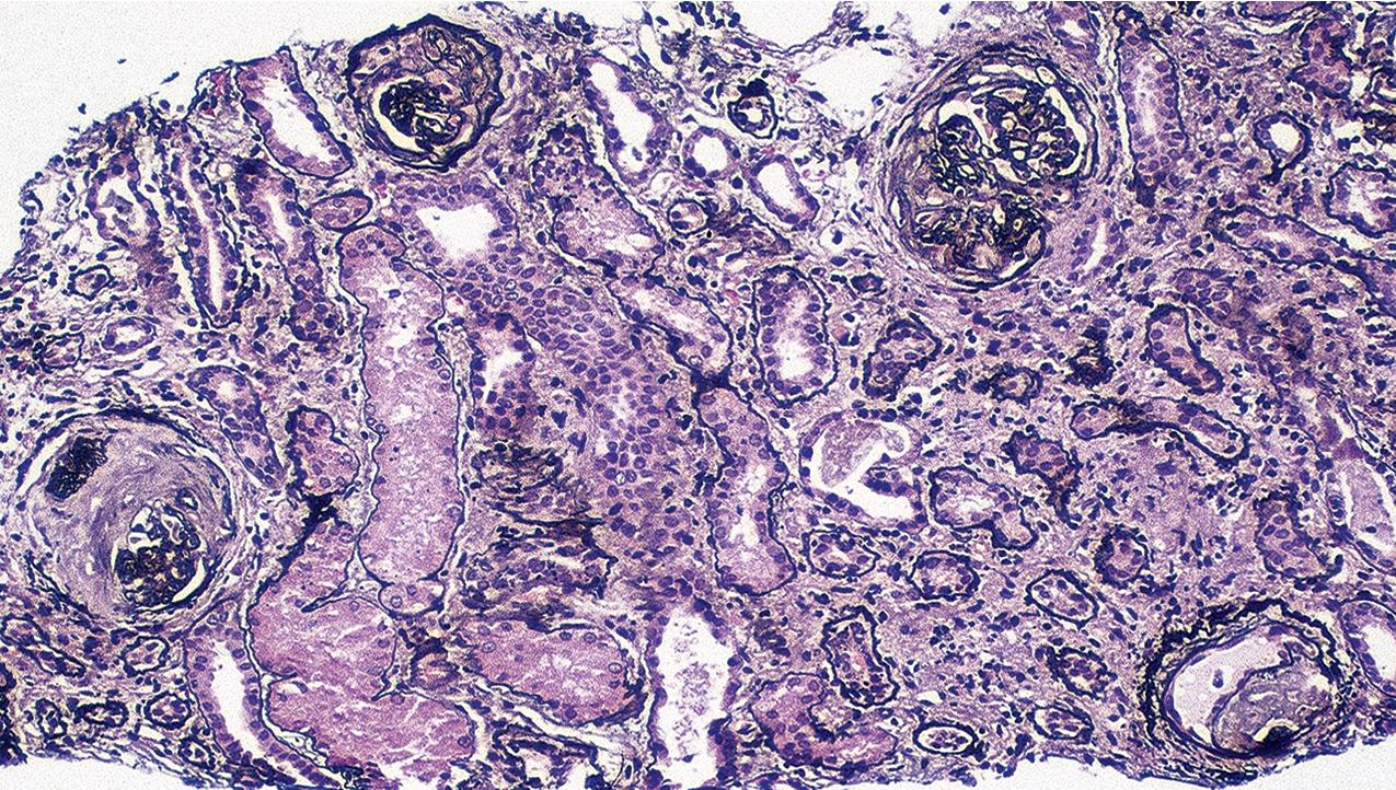 FIG. 3.10, Focal segmental glomerulosclerosis (FSGS).