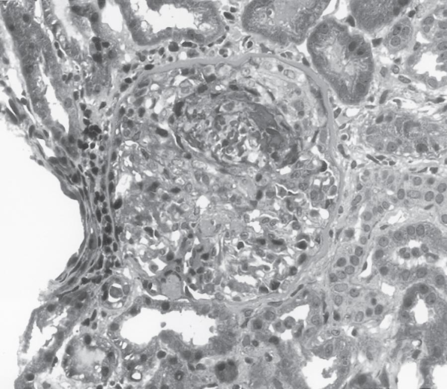 Fig. 103.1, Rapidly Progressive Glomerulonephritis.