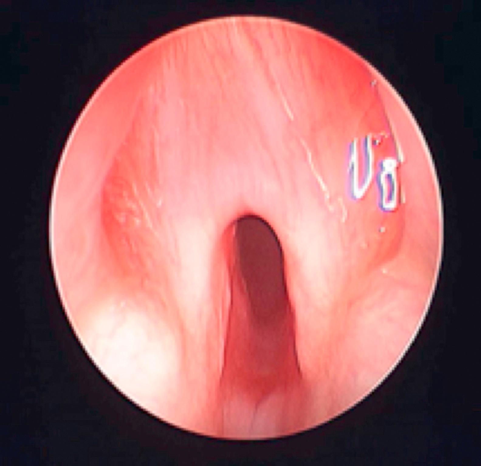 Fig. 28.1, Endoscopic view of an anterior glottic web.