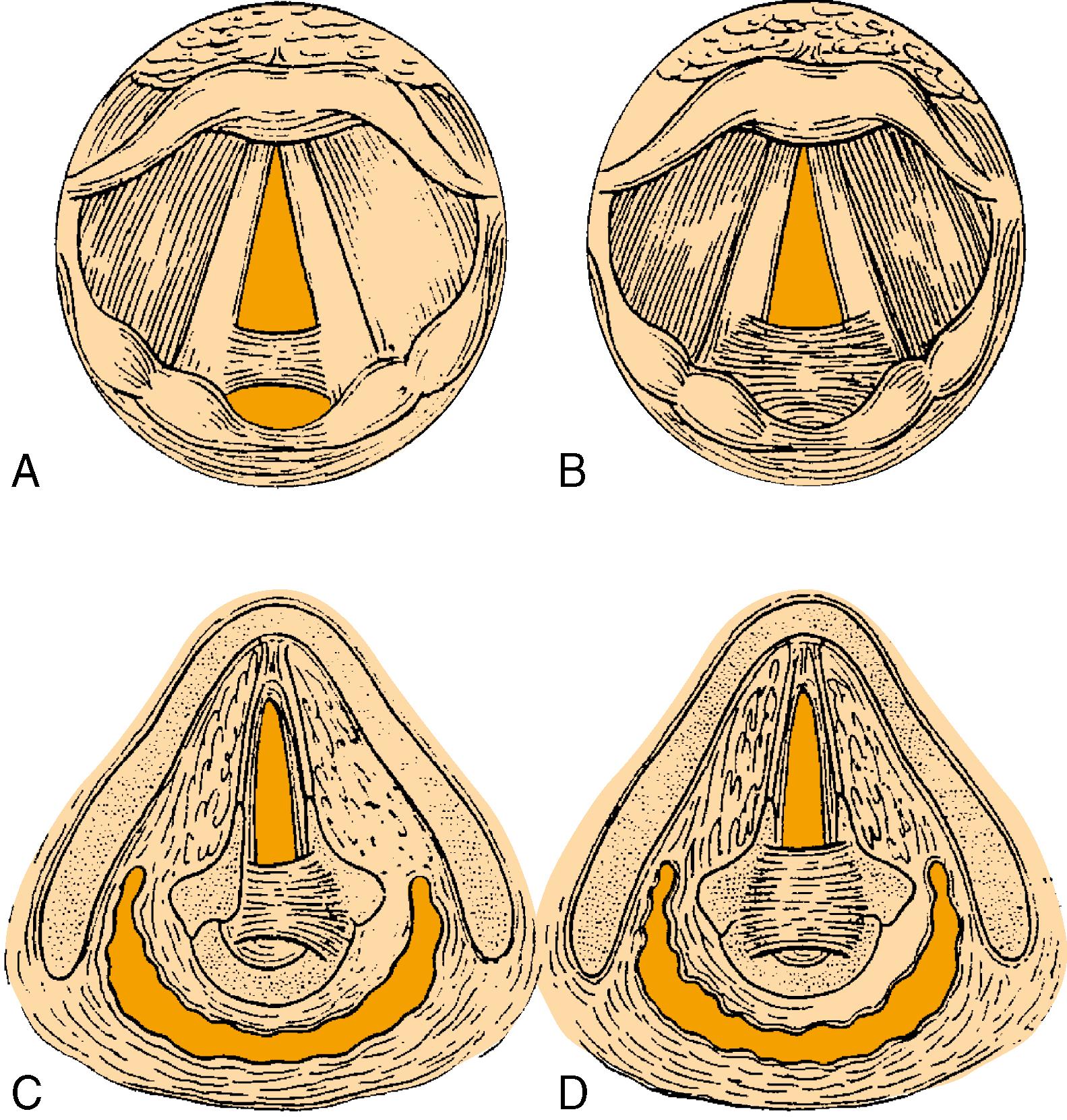 Fig. 28.2, Bogdasarian grading of posterior glottic stenosis. (A) Grade I, interarytenoid synechia with a sinus tract posteriorly. (B) Grade II, interarytenoid and posterior commissure scarring. (C) Grade III, posterior commissure scarring involving one. cricoarytenoid joint. (D) Grade IV, posterior commissure scarring involving both cricoarytenoid joints.