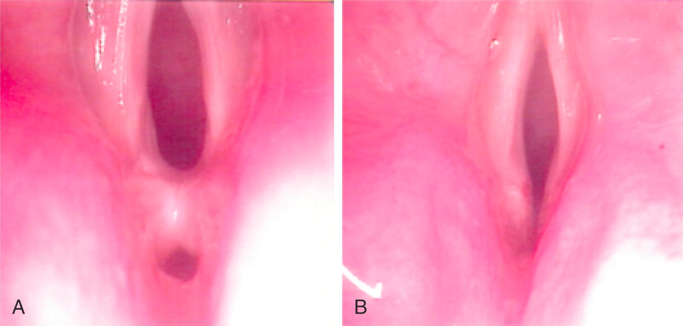 Fig. 28.3, Endoscopic view of Bogdasarian grade I posterior glottic stenosis demonstrating interarytenoid synechiae with a fistulous tract posteriorly. (A) Preoperative view. (B) After endoscopic division of scar.