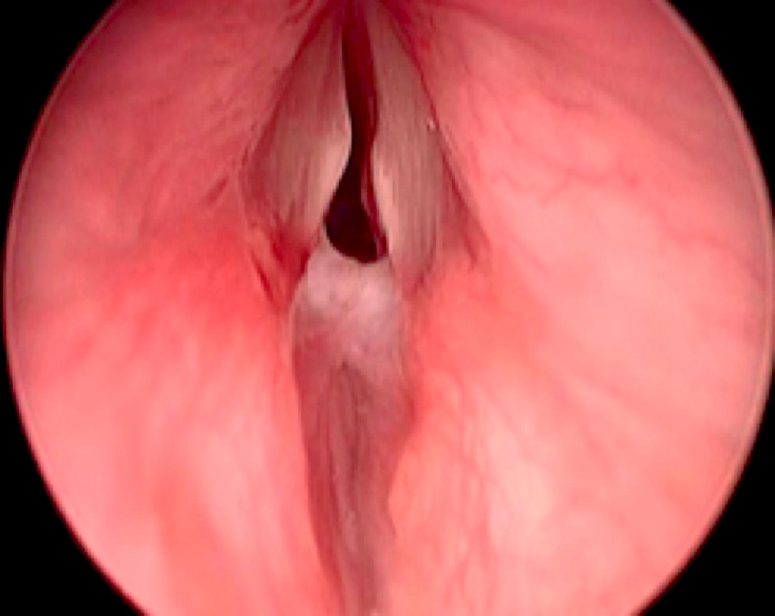 Fig. 28.4, Endoscopic view of Bogdasarian grade II posterior glottic stenosis.