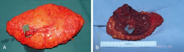 Figure 44.1, (A) The pedicle length of the SGAP flap and (B) gluteus maximus musculocutaneous flap.