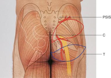 Figure 44.2, Flap design of the superior gluteal flap (red line) and the inferior gluteal flap (blue line) based on either the SGA or IGA vessels and their relationship with the anatomic landmarks. PSIS, posterior superior iliac spine; C, coccyx; T, greater trochanter.