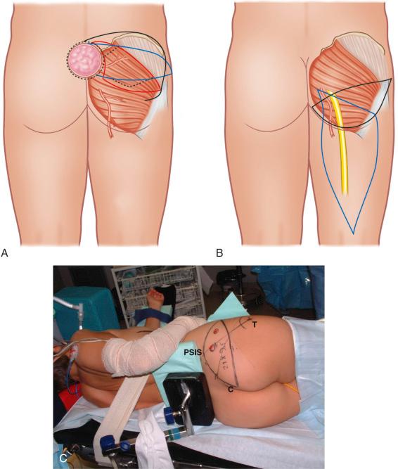 Figure 44.3, Gluteal flap design.