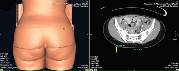 Figure 44.4, CT angio scan shows clearly the location of the perforator when it raises from the gluteus muscle (A).