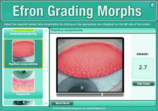 Fig. 3.1, Efron Grading Morphs program window. In this example, the papillary conjunctivitis morph is active.