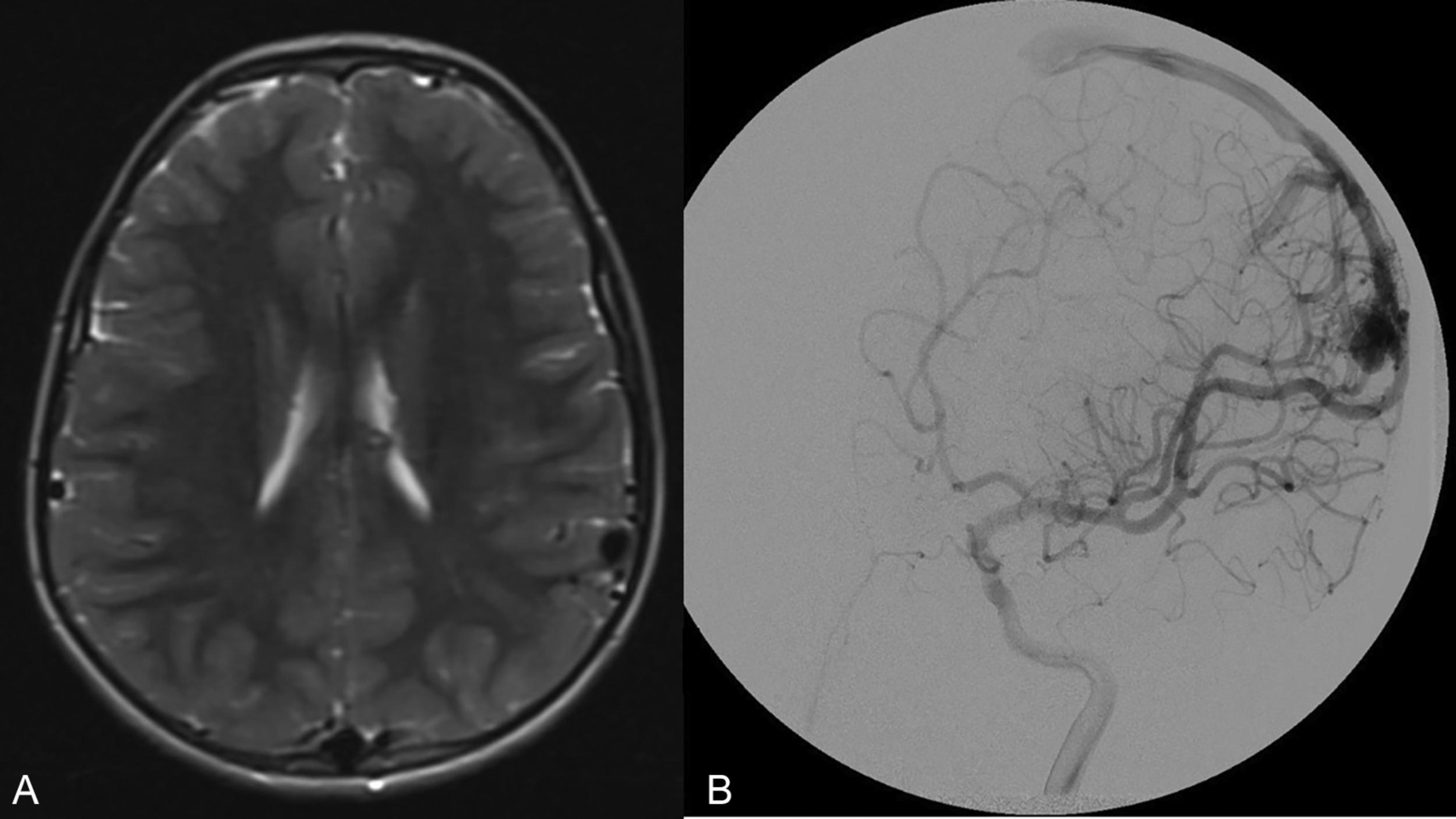 Fig. 19.1, Spetzler-Martin grade I AVM. ( A ) T2-weighted MR image and ( B ) lateral digital subtraction angiogram demonstrating a Spetzler-Martin grade I AVM with a small (< 3 cm) nidus in a superficial, noneloquent location with superficial venous drainage.