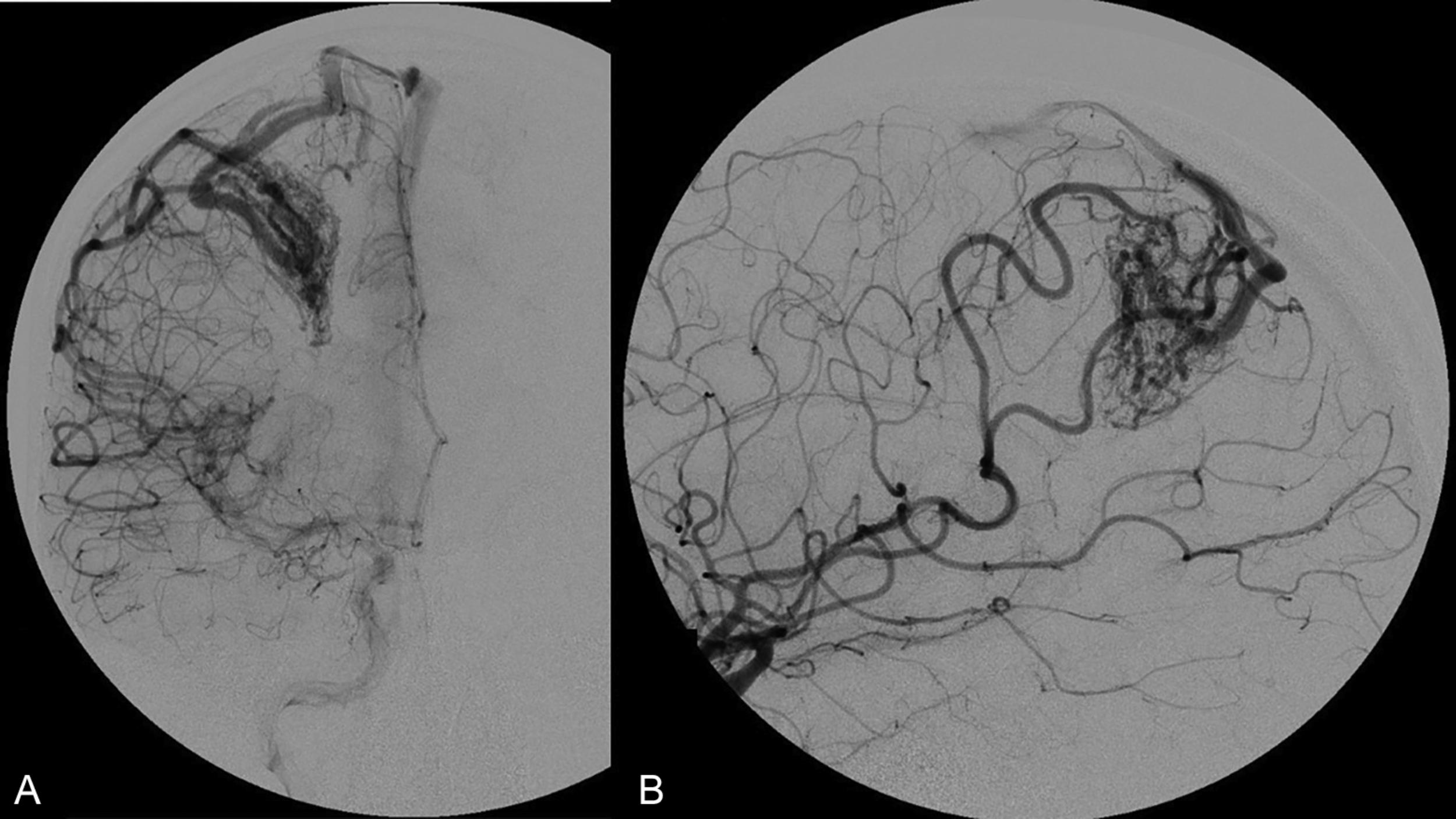 Fig. 19.2, Spetzler-Martin grade II AVM. ( A ) Anterior-posterior and ( B ) lateral digital subtraction angiograms demonstrating a Spetzler-Martin grade II AVM with a medium-size (3–6 cm) nidus in a superficial, noneloquent location with superficial venous drainage.