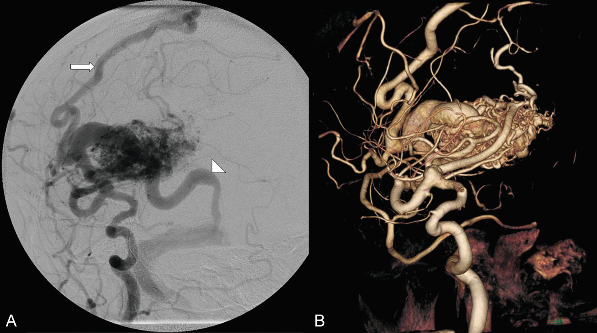 Fig. 19.3, Spetzler-Martin grade III AVM. ( A ) Lateral digital subtraction angiogram and ( B ) 3D reconstruction of Spetzler-Martin grade III AVM with a medium-size (3–6 cm) nidus in a superficial, eloquent location with superficial venous drainage via cortical veins of Troland (arrow) and Labbé (arrowhead) into the superior sagittal sinus and transverse sigmoid sinus, respectively.
