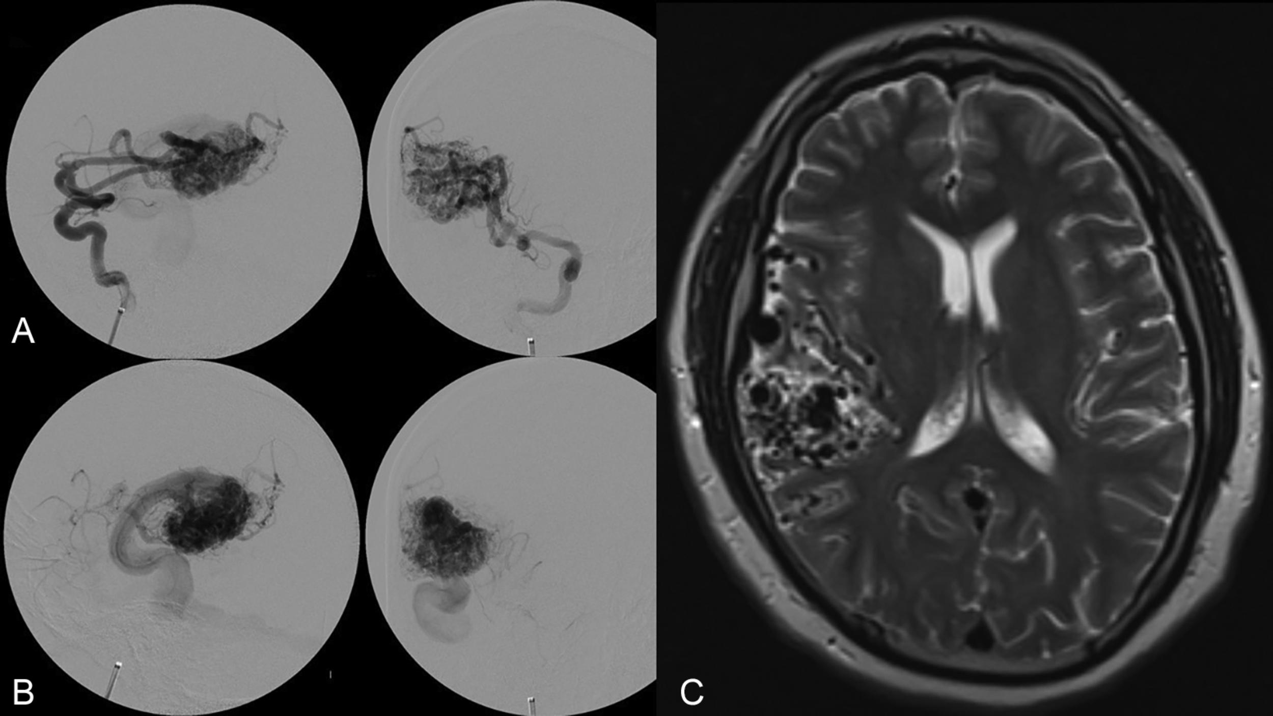 Fig. 19.4, Spetzler-Martin grade IV AVM. ( A ) Late arterial phase and ( B ) early venous phase lateral (left) and anterior-posterior (right) view digital subtraction angiograms displaying a Spetzler-Martin grade IV AVM with a large (> 6 cm) diffuse nidus in an eloquent location with superficial venous drainage. ( C ) T2-weighted MR image showing the extent of the nidus and the surrounding brain parenchyma.