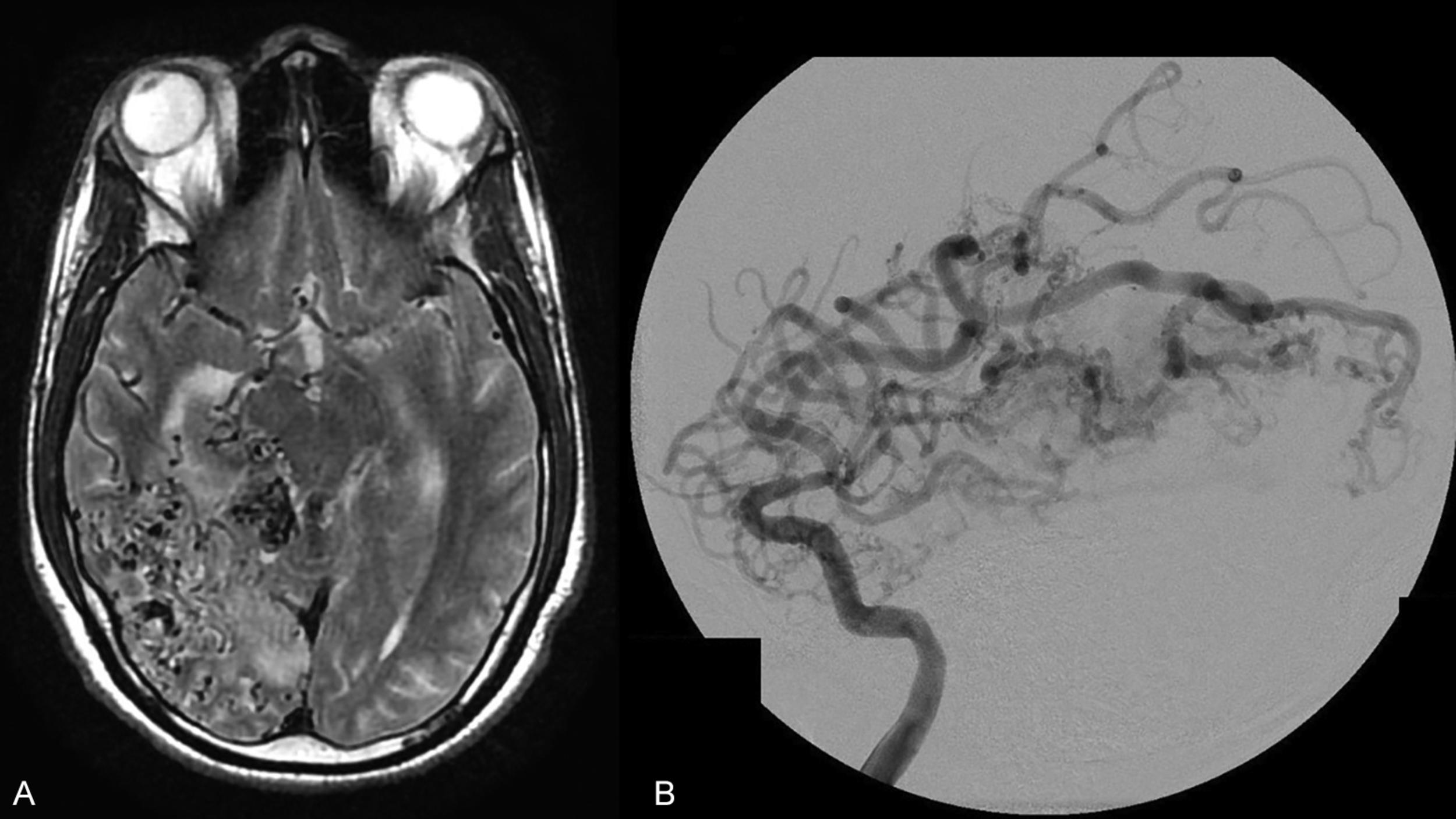 Fig. 19.5, Spetzler-Martin grade V AVM. ( A ) Axial T2-weighted MR image showing a large right temporal-parietal-occipital AVM with a diffuse nidus. ( B ) Lateral-projection digital subtraction angiogram highlighting the features of a Spetzler-Martin grade V AVM with a large (> 6 cm) nidus, involvement of eloquent territory, and deep venous drainage.