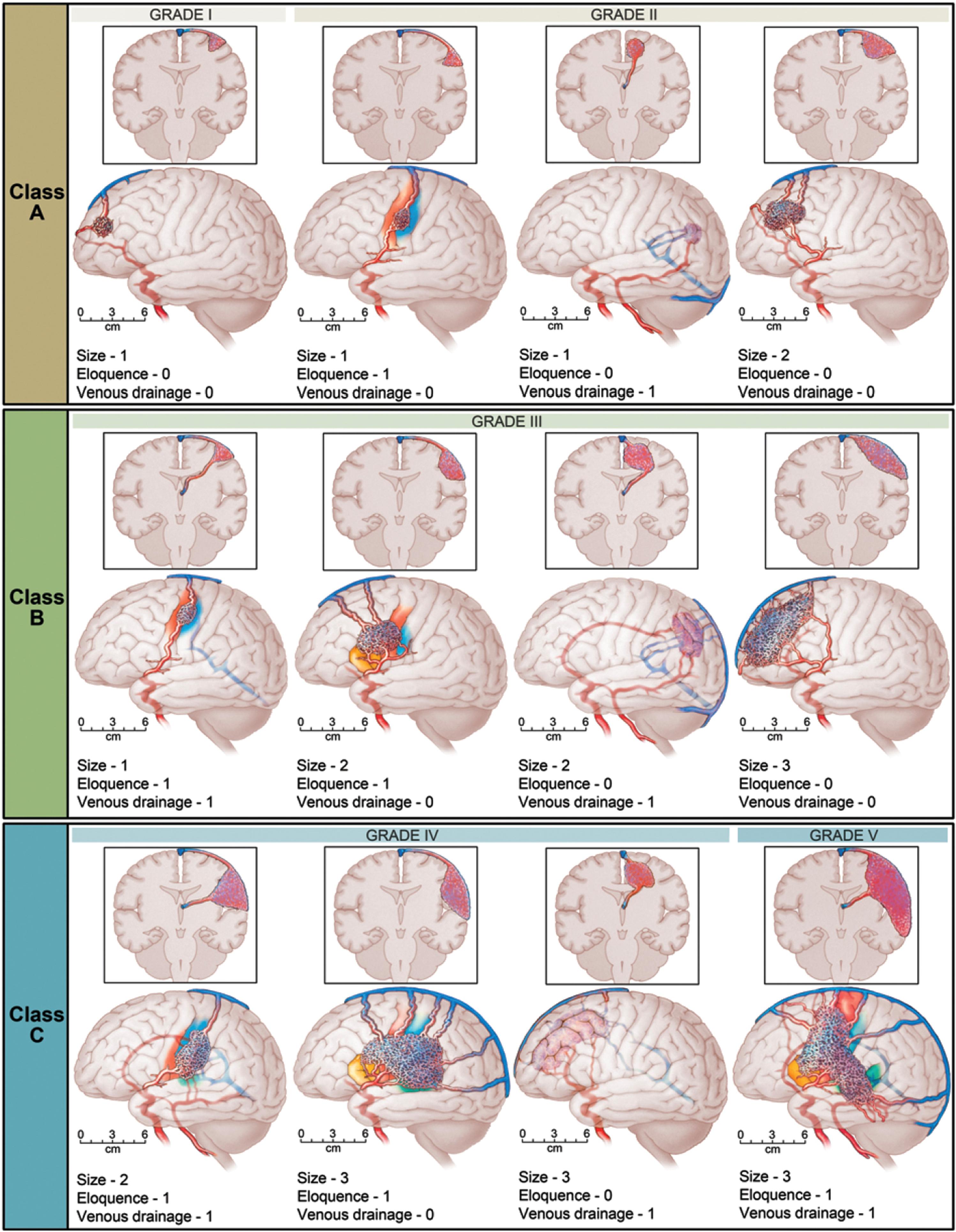 Fig. 19.6, Diagrammatic representation of the combinations of graded variables (size, eloquence, and venous drainage) for each class of AVM. The Spetzler-Martin system assigns a score of 1 for small AVMs (< 3 cm), 2 for medium (3–6 cm), and 3 for large (> 6 cm). The eloquence of the adjacent brain is scored as either noneloquent (0) or eloquent (1). The venous drainage is scored as superficial only (0) or including drainage to the deep cerebral veins (1). Scores for each feature are totaled to determine the grade. In the Spetzler-Ponce modification, class A includes Spetzler-Martin grades I and II; class B includes grade III; and class C includes grades IV and V.