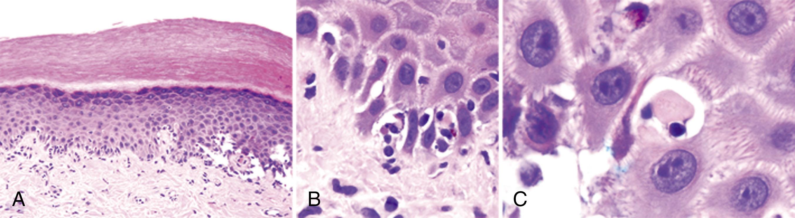 Figure 109.1, GRAFT-VERSUS-HOST DISEASE, SKIN BIOPSY.