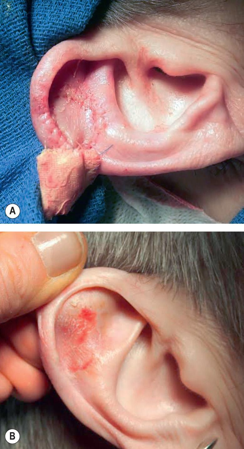 Fig. 148.2, Full-thickness skin graft.