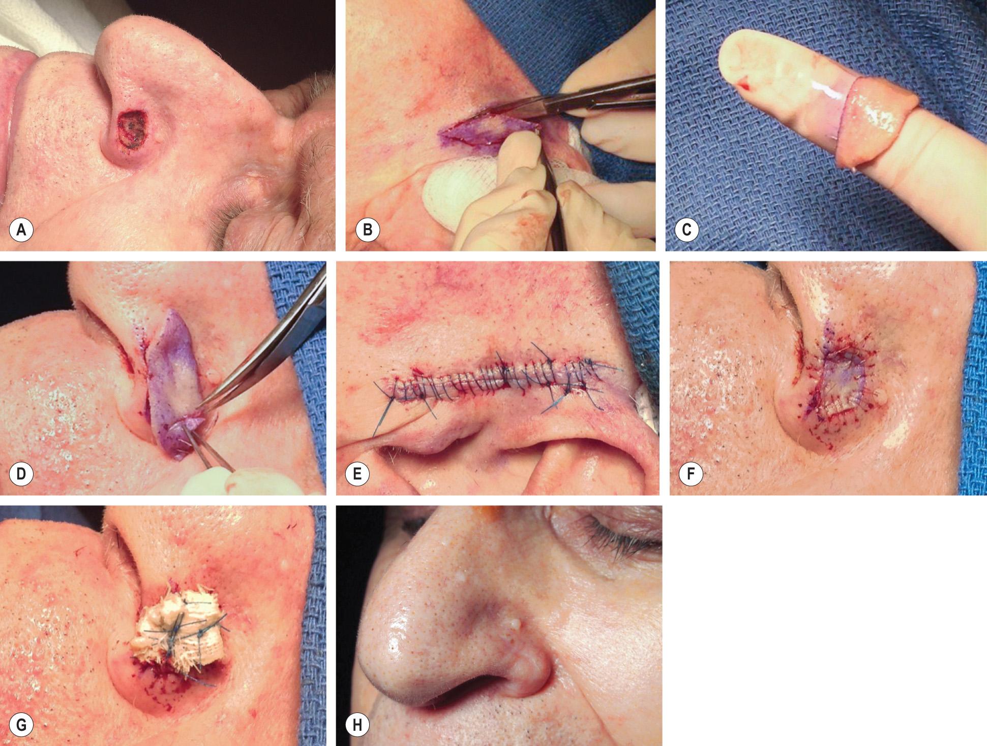 Fig. 148.3, Placement of a full-thickness skin graft.