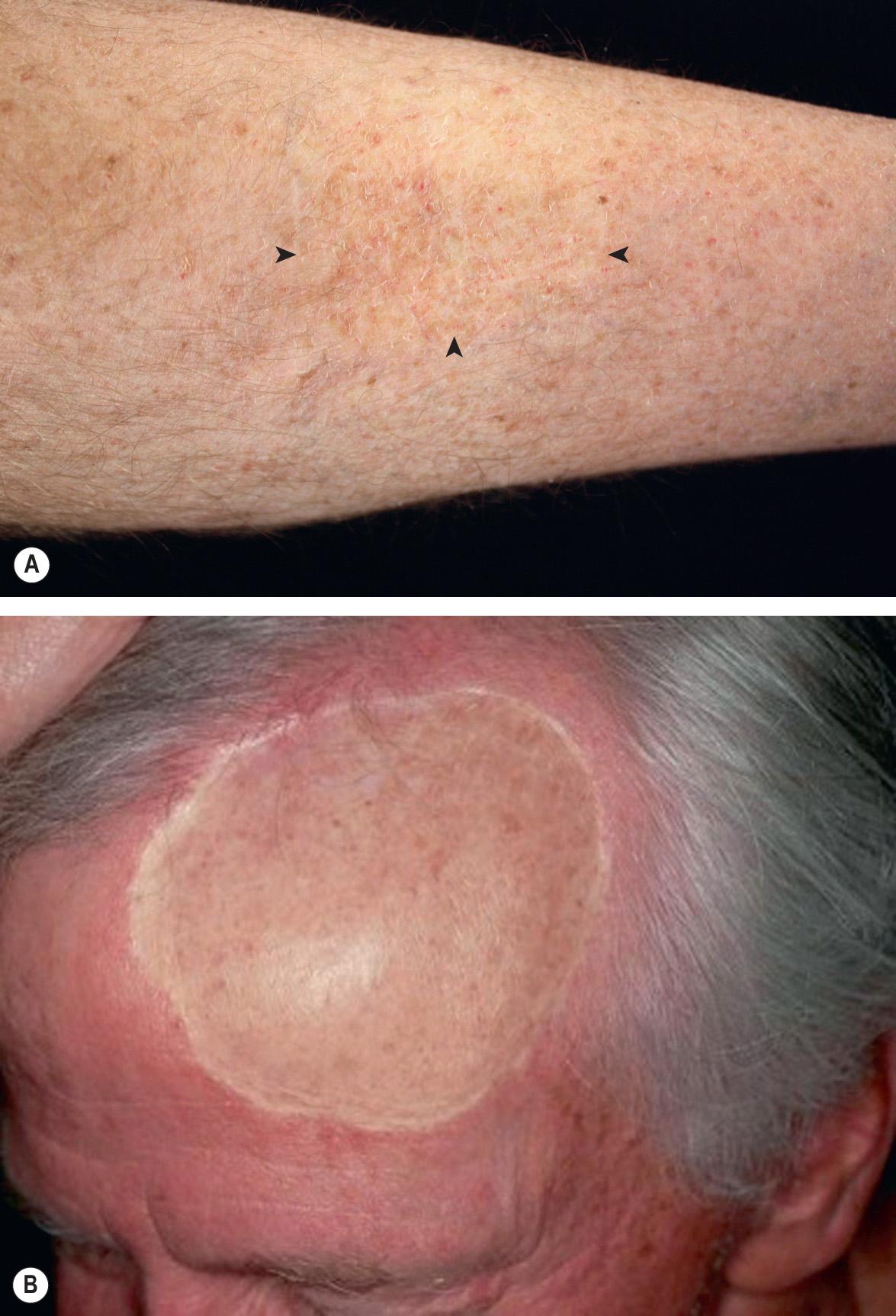 Fig. 148.4, Split-thickness skin grafts (STSGs).