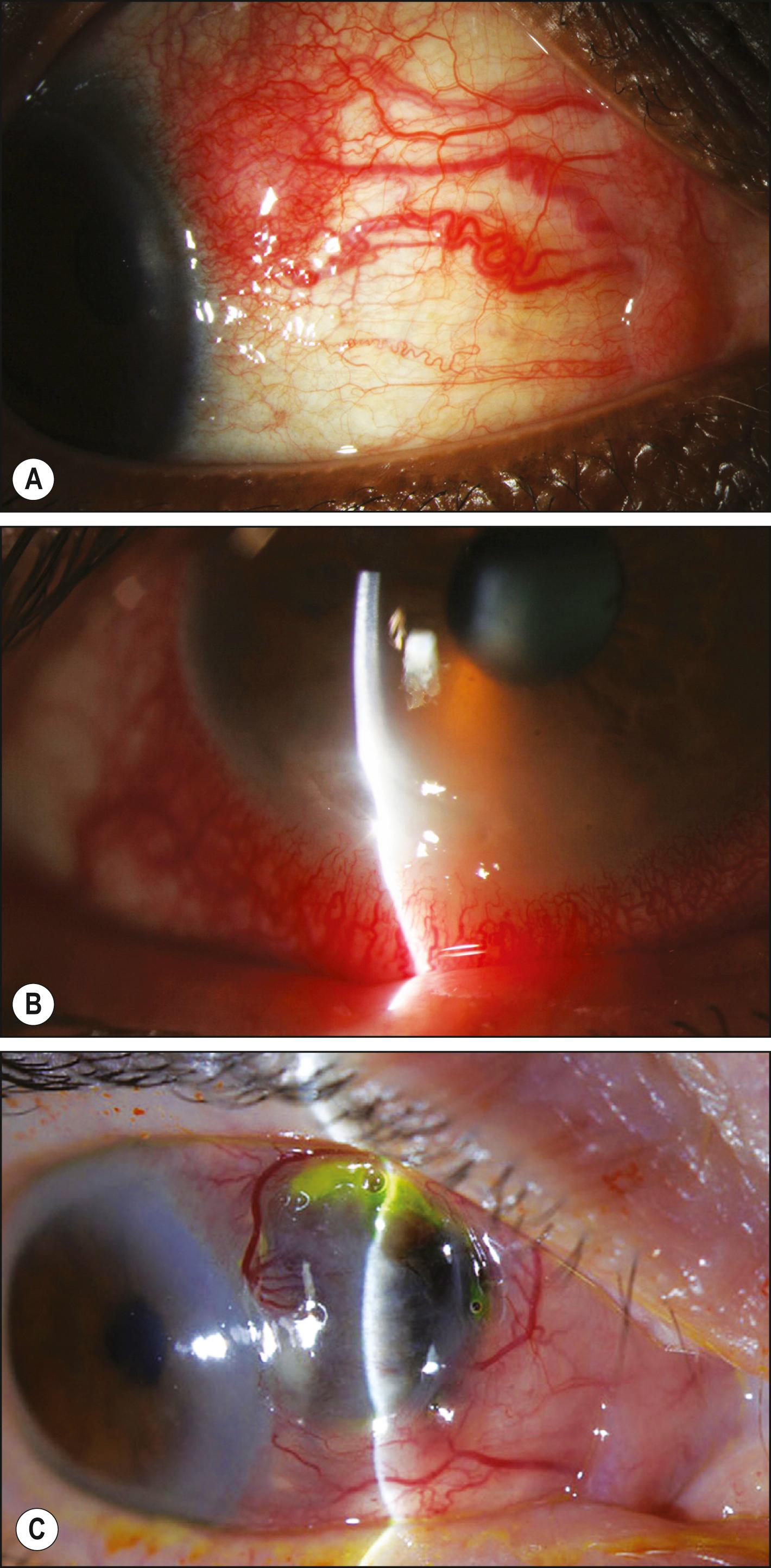 Fig. 60.1, Granulomatosis with polyangiitis.