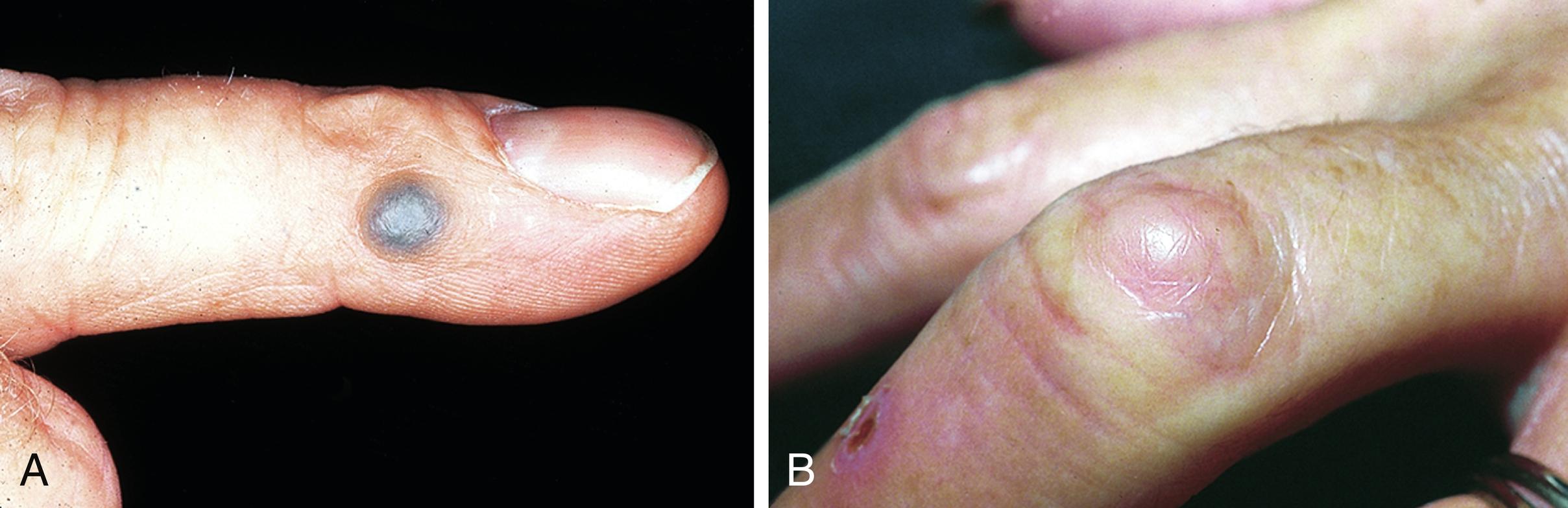 Fig. 13.1, A, Typical graphite granuloma due to pencil lead injury. B, Skin-colored nodule due to yucca thorn embedded in the skin for several years.