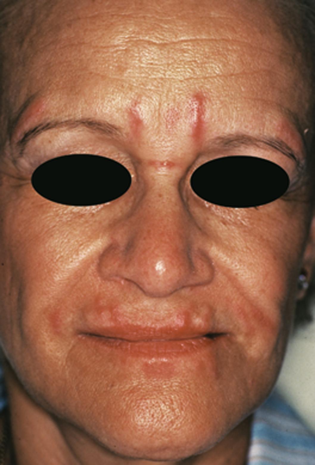 Fig. 13.2, Patient with foreign body reaction to cosmetic filler demonstrating erythematous papules and linear lesions at the site of bovine collagen injection.