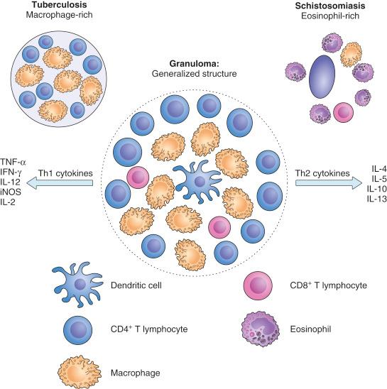 Fig. 28.2, Generalized and specialized structural and functional characteristics of hepatic granulomas. The cellular constituents of hepatic granulomas are diagrammed at the bottom. Note that tuberculosis macrophage-rich granulomas show a type 1 T helper (Th1)–predominant lymphocytic response, with release of Th1 cytokines. In schistosomiasis, in contrast, enhanced numbers of eosinophils are present within the granulomas (mediated by secretion of interleukin 5 [IL-5]). In addition, release of IL-13 in schistosomiasis is an important factor resulting in portal fibrosis in the disease. IFN-γ, Interferon-gamma; iNOS, inducible nitric oxide synthetase; TNF-α, tumor necrosis factor alpha.