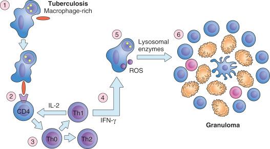 Fig. 28.3, Development of a granuloma (red rods represent mycobacteria). Step 1: A macrophage engulfs mycobacterium. Step 2: Macrophage presentation of mycobacterial protein product(s) to a receptor on CD4+ lymphocytes. Step 3: CD4+ lymphocytes differentiate to precursor T helper lymphocytes (Th0), later differentiating into Th1 lymphocytes. Step 4: Th1 lymphocytes secrete interleukin 2 (IL-2), a clonal expander of CD4+ cells, as well as interferon gamma (IFN-γ), which upregulates lysosomal enzymes and reactive oxygen species (ROS) in macrophages in step 5. Step 6: Further recruitment of macrophages and lymphocytes with ongoing digestion of mycobacteria.