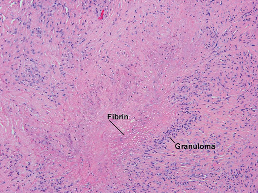 Fig. 10.12, Rheumatoid nodule