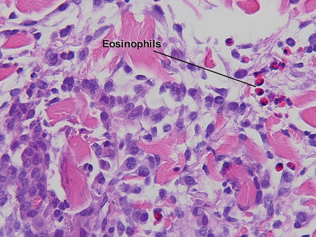 Fig. 10.3, Granuloma annulare