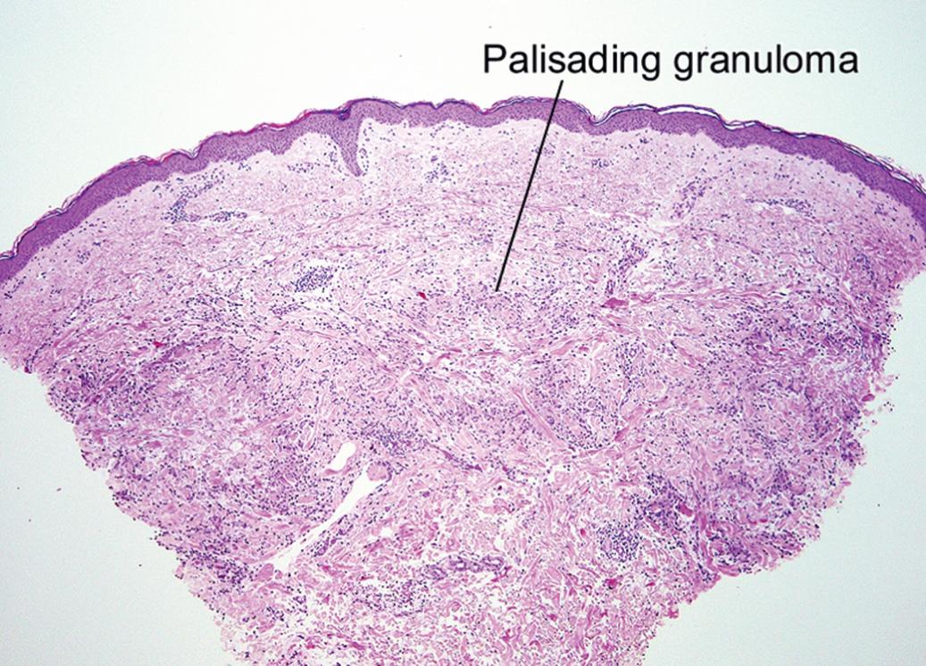 Fig. 10.4, Palisading granuloma annulare