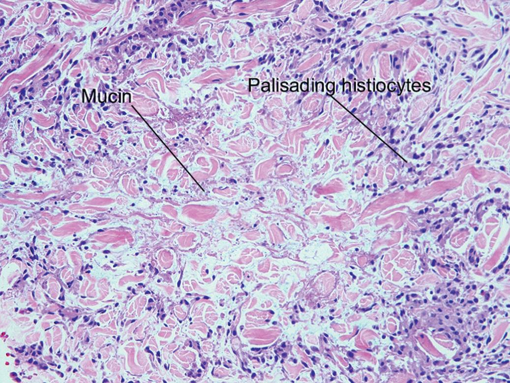 Fig. 10.5, Palisading granuloma annulare