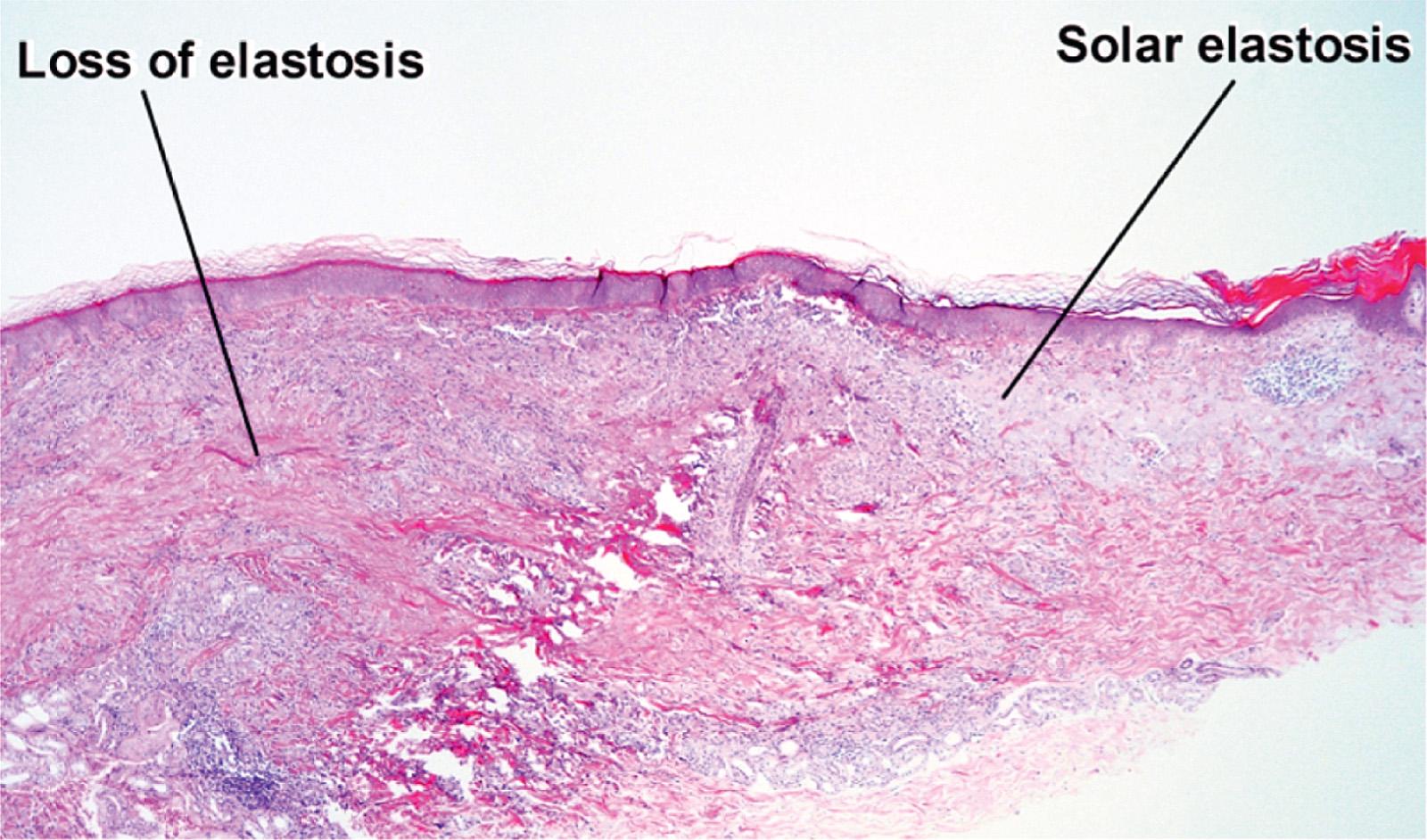 Fig. 10.6, Actinic granuloma