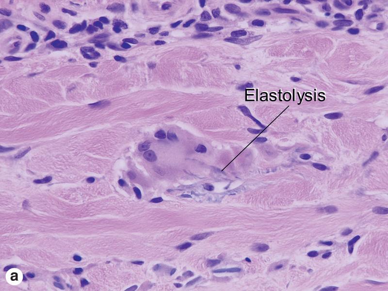 Fig. 10.7, Actinic granuloma