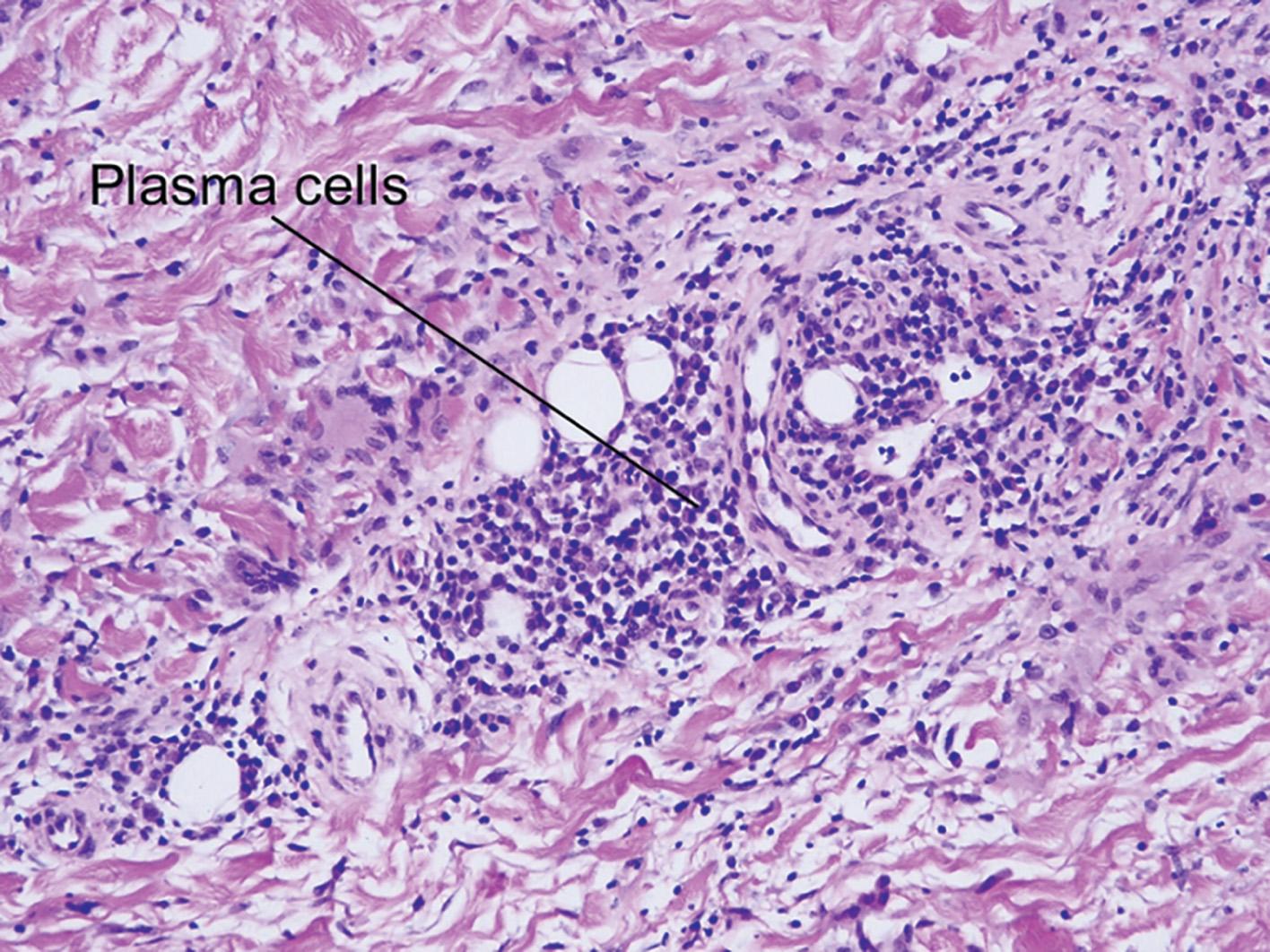 Fig. 10.10, Necrobiosis lipoidica