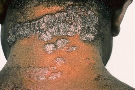 Fig. 9.1, Sarcoidosis: this patient presented with multiple plaques with raised margins on the neck.