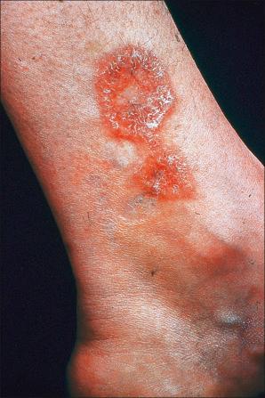 Fig. 9.12, Sarcoidosis: annular lesions on the ankle.