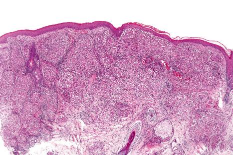 Fig. 9.17, Sarcoidosis: the dermis is replaced by uniform circumscribed nests of noncaseating granulomata.